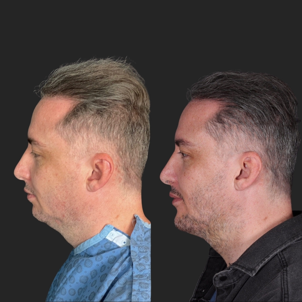 #2 (1) Facial Implants, 38 y.o., 5 days