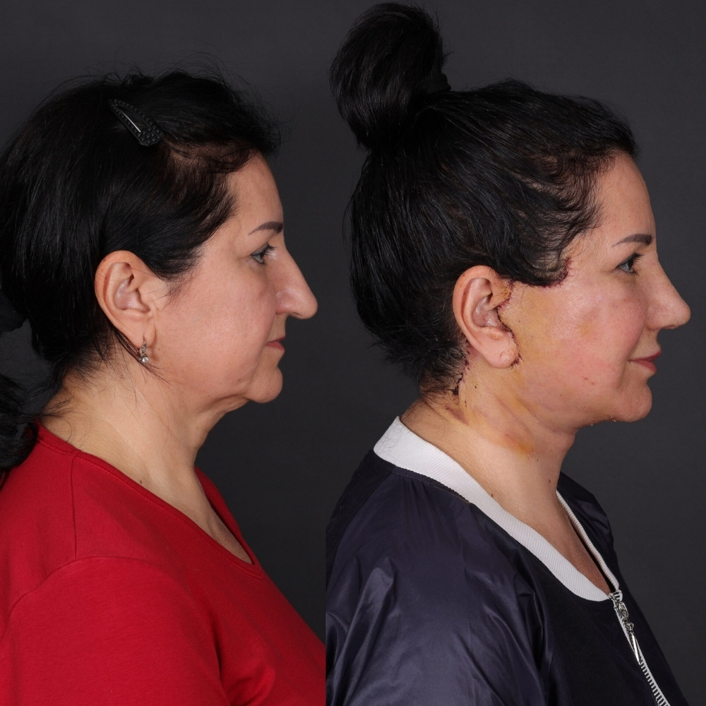 #2 (2) Double Chin Removal, 55 y.o., 10 days