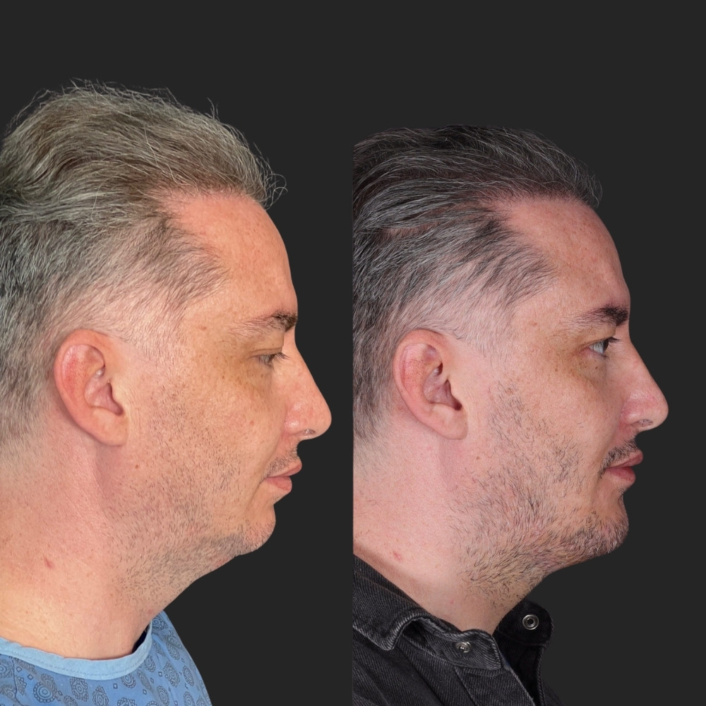 #2 (2) Facial Implants, 38 y.o., 5 days