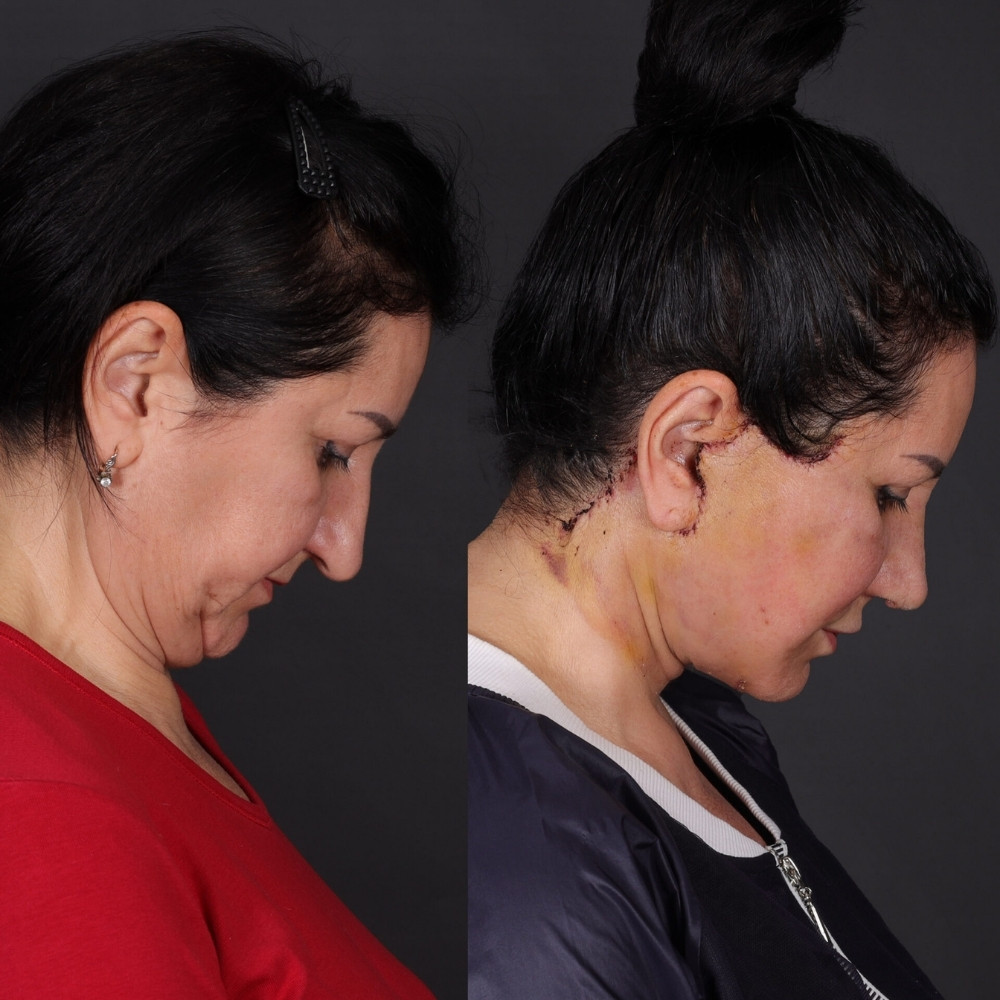 #2 (3) Double Chin Removal, 55 y.o., 10 days