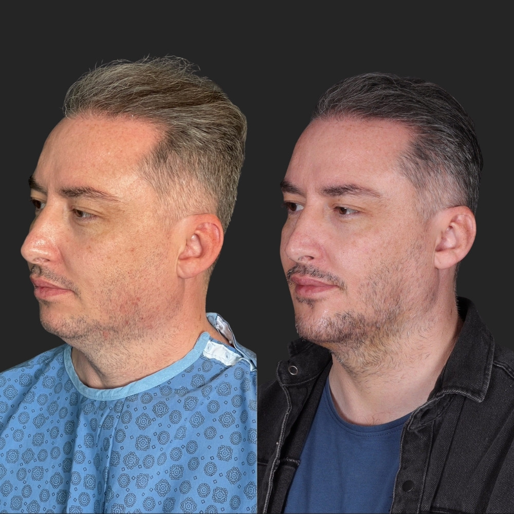 #2 (3) Facial Implants, 38 y.o., 5 days