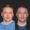 #2 (4) Facial Implants, 38 y.o., 5 days