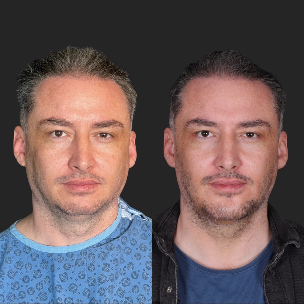 #2 (4) Facial Implants, 38 y.o., 5 days