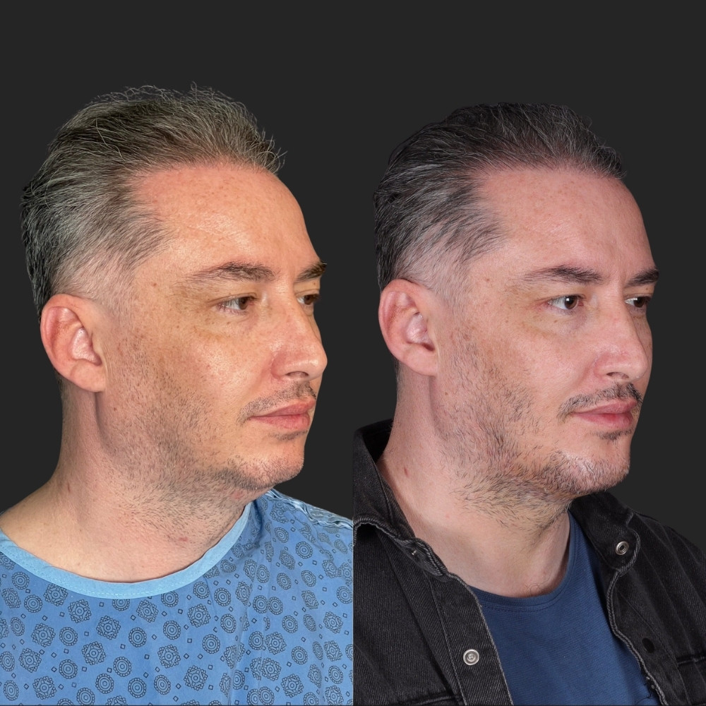 #2 (5) Facial Implants, 38 y.o., 5 days