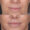 #2 Lip Lift, 51 y.o., 15 days