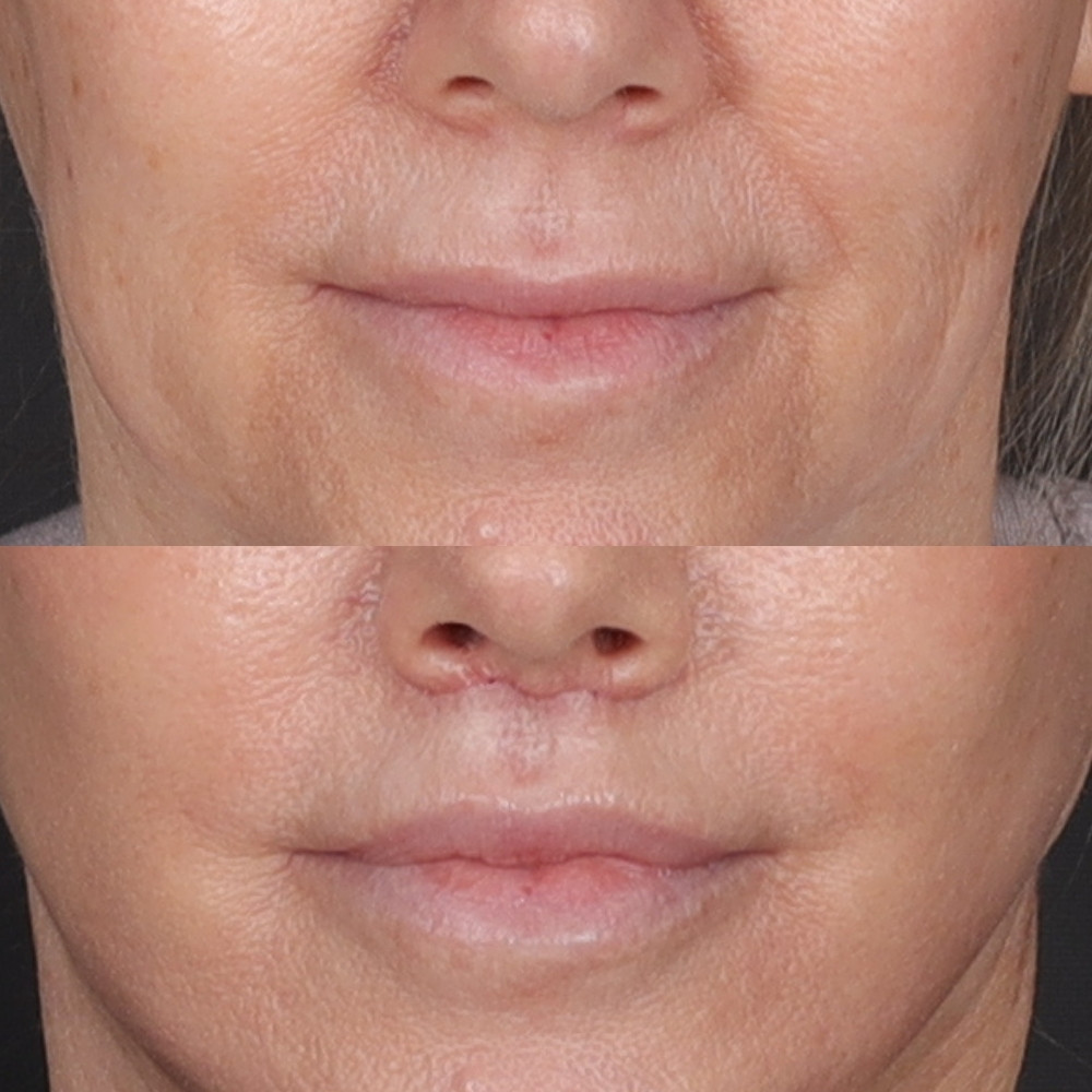 #2 Lip Lift, 51 y.o., 15 days