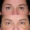 #2 Low. Eyelid, 54 y.o., 10 days
