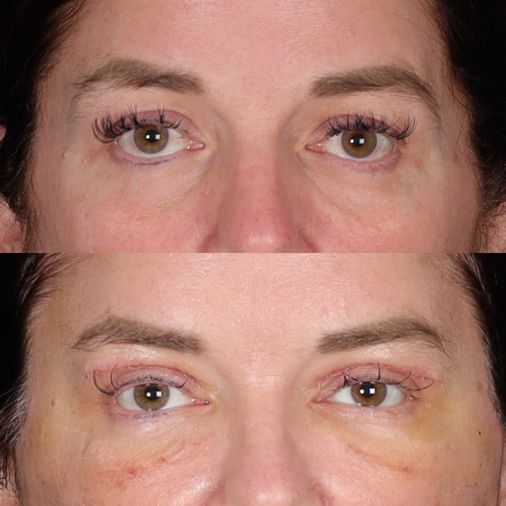 #2 Low. Eyelid, 54 y.o., 10 days