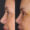 #2 Up. Eyelid, 56 y.o., 9 days