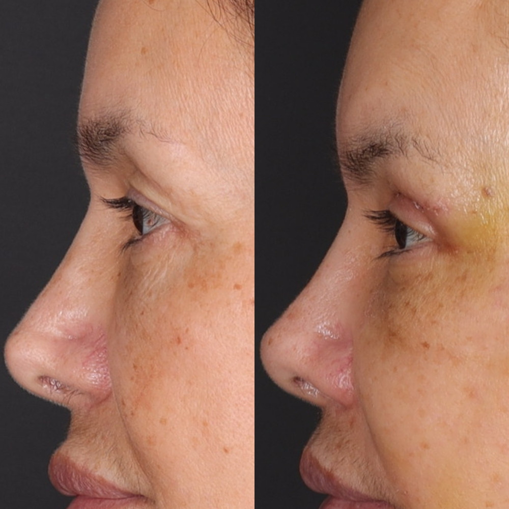 #2 Up. Eyelid, 56 y.o., 9 days