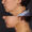 #3 Chin Implant, 42 years old, 9 days