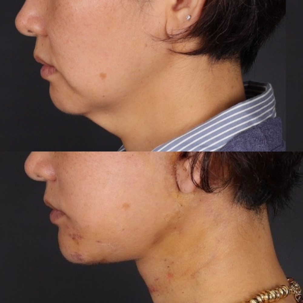 #3 Chin Implant, 42 years old, 9 days