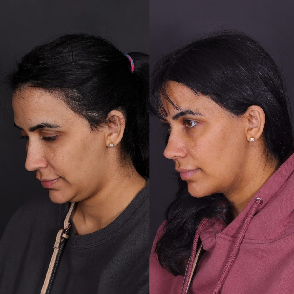 #3 Double Chin Removal, 32 y.o., 10 days