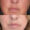 #3 Lip Lift, 56 y.o., 18 days
