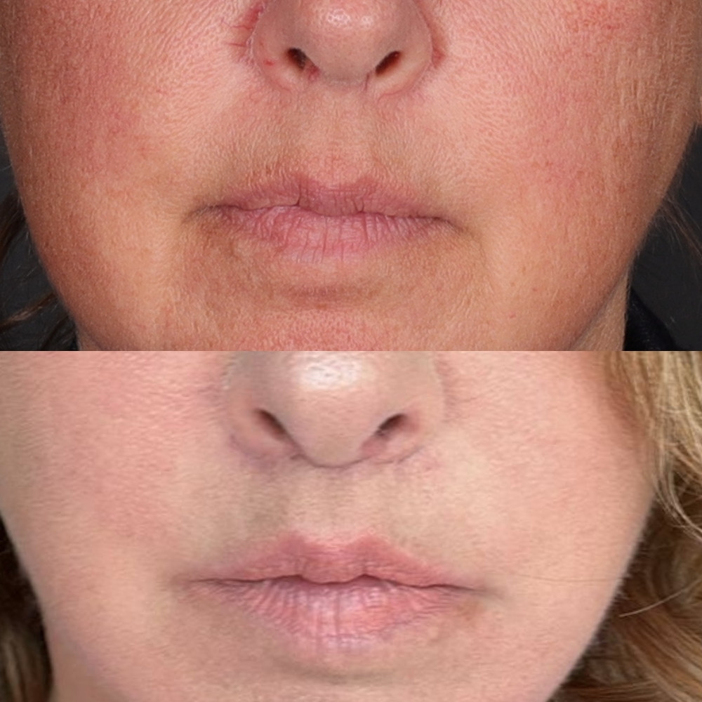 #3 Lip Lift, 56 y.o., 18 days