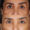 #3 Low. Eyelid, 55 y.o., 17 days