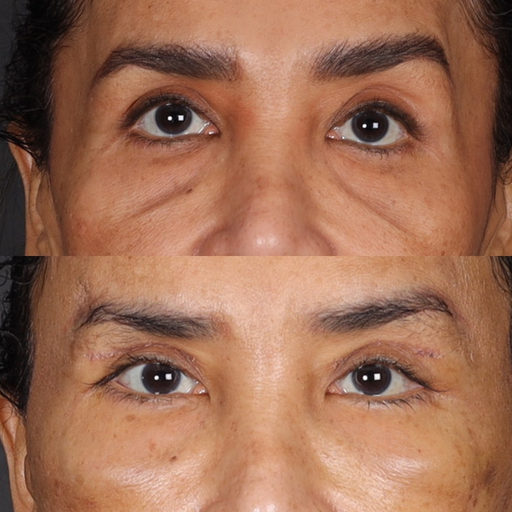 #3 Low. Eyelid, 55 y.o., 17 days