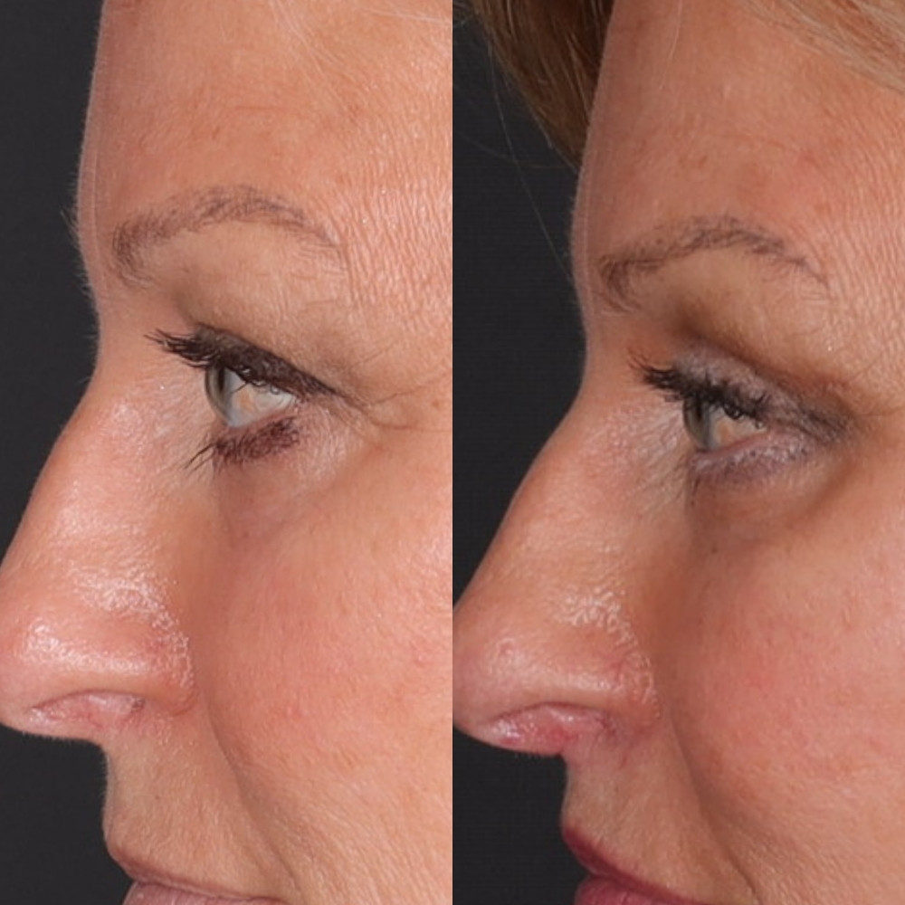 #3 Up. Eyelid, 56 y.o., 3 months