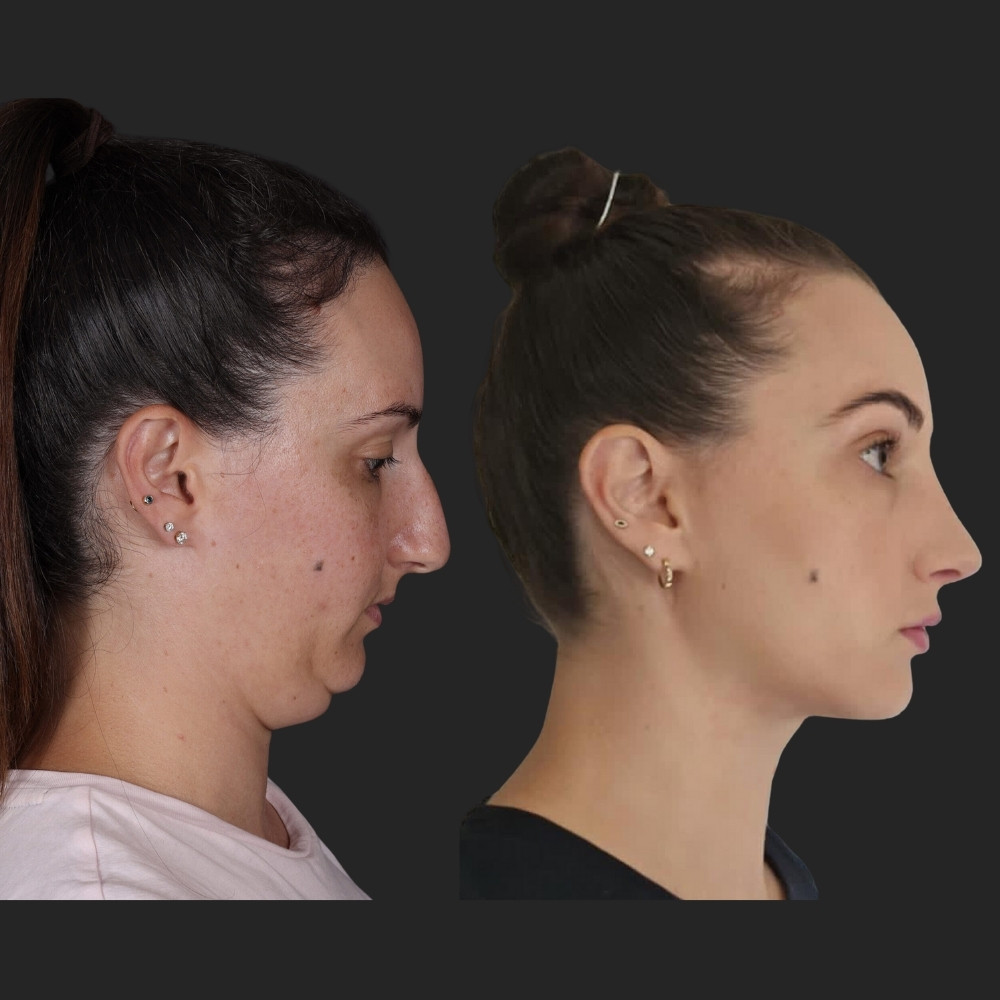 #4 Double Chin Removal, 34 y.o., 1 year