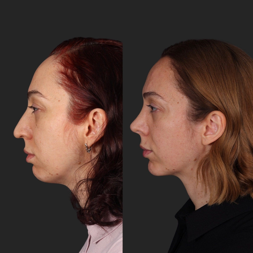 #4 Facial Implants, 38 y.o., 8 months