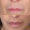#4 Lip Lift, 58 y.o., 2 months