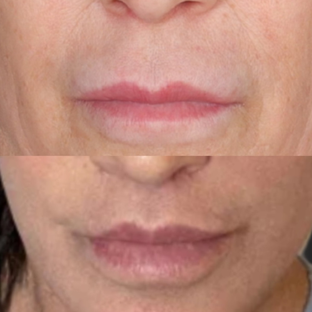 #4 Lip Lift, 58 y.o., 2 months