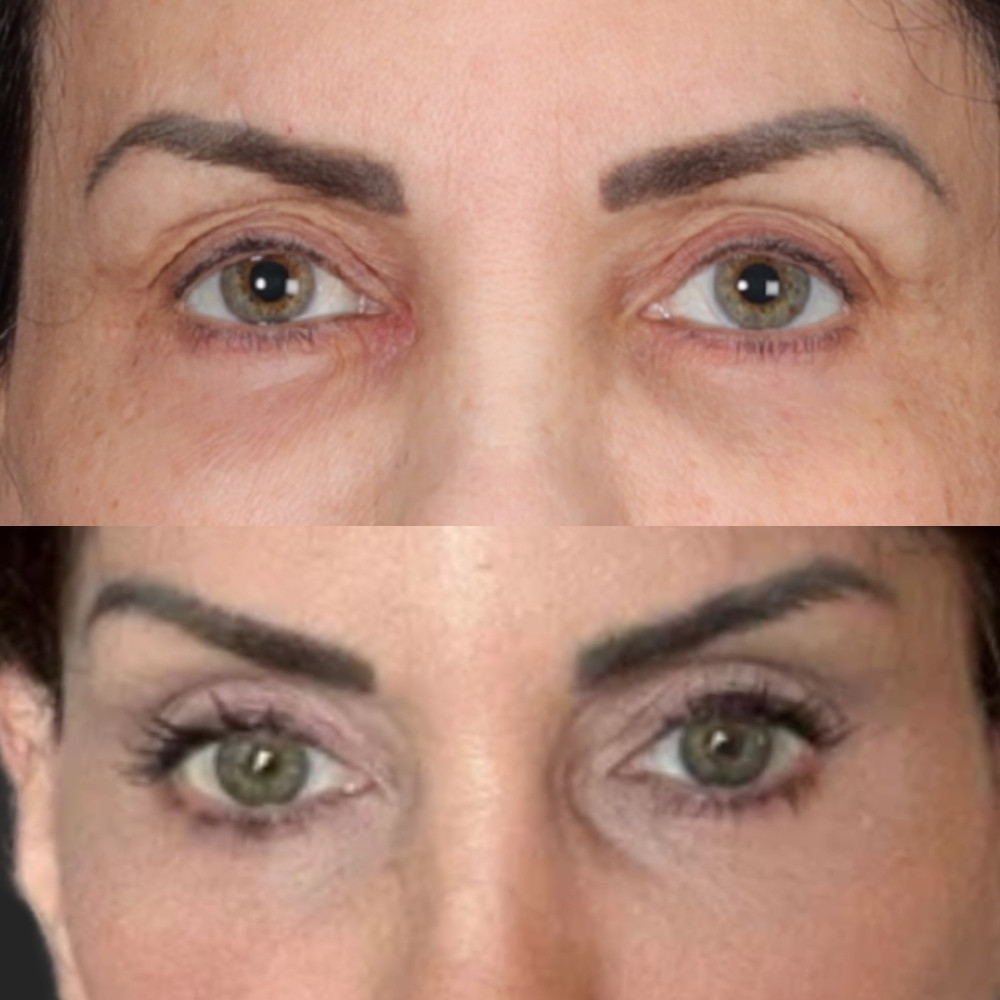 #4 Up. Eyelid, 58 y.o., 2 months