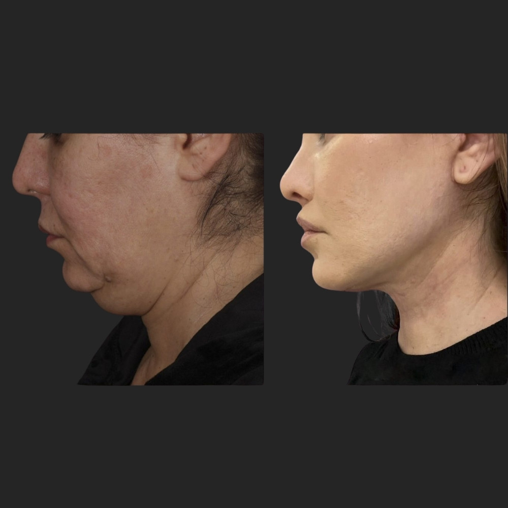 #5 Double Chin Removal, 56 y.o., 3 months
