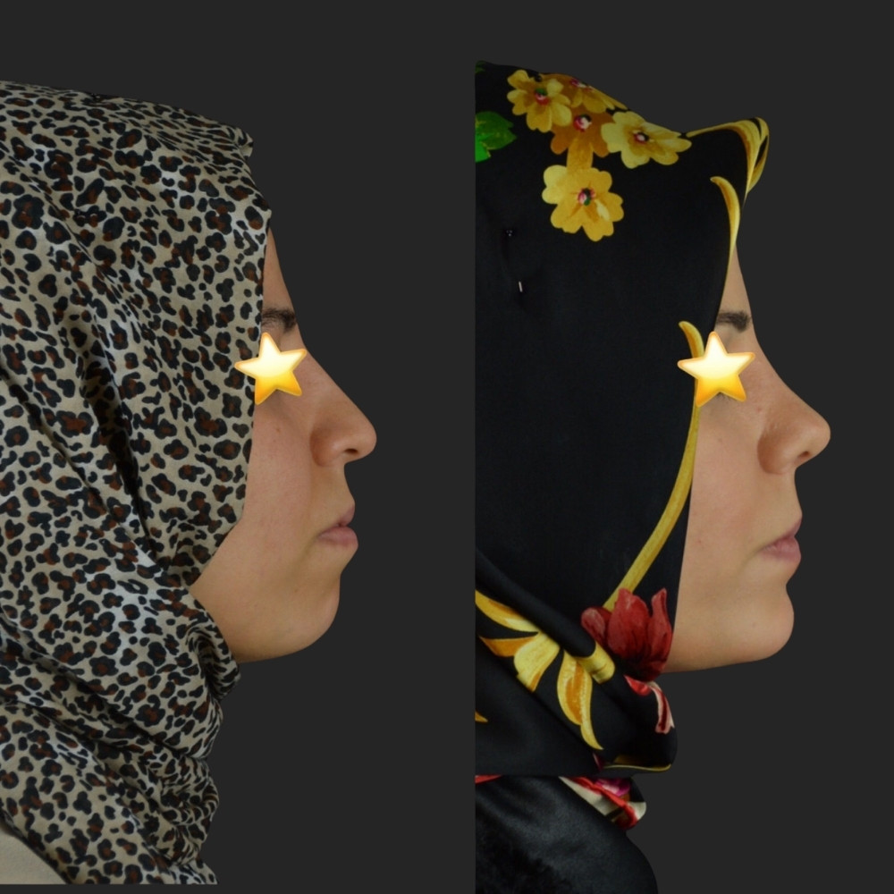 #5 Facial Implants, 32 y.o., 1 month