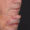 #5 Lip Lift, 74 y.o., 8 days