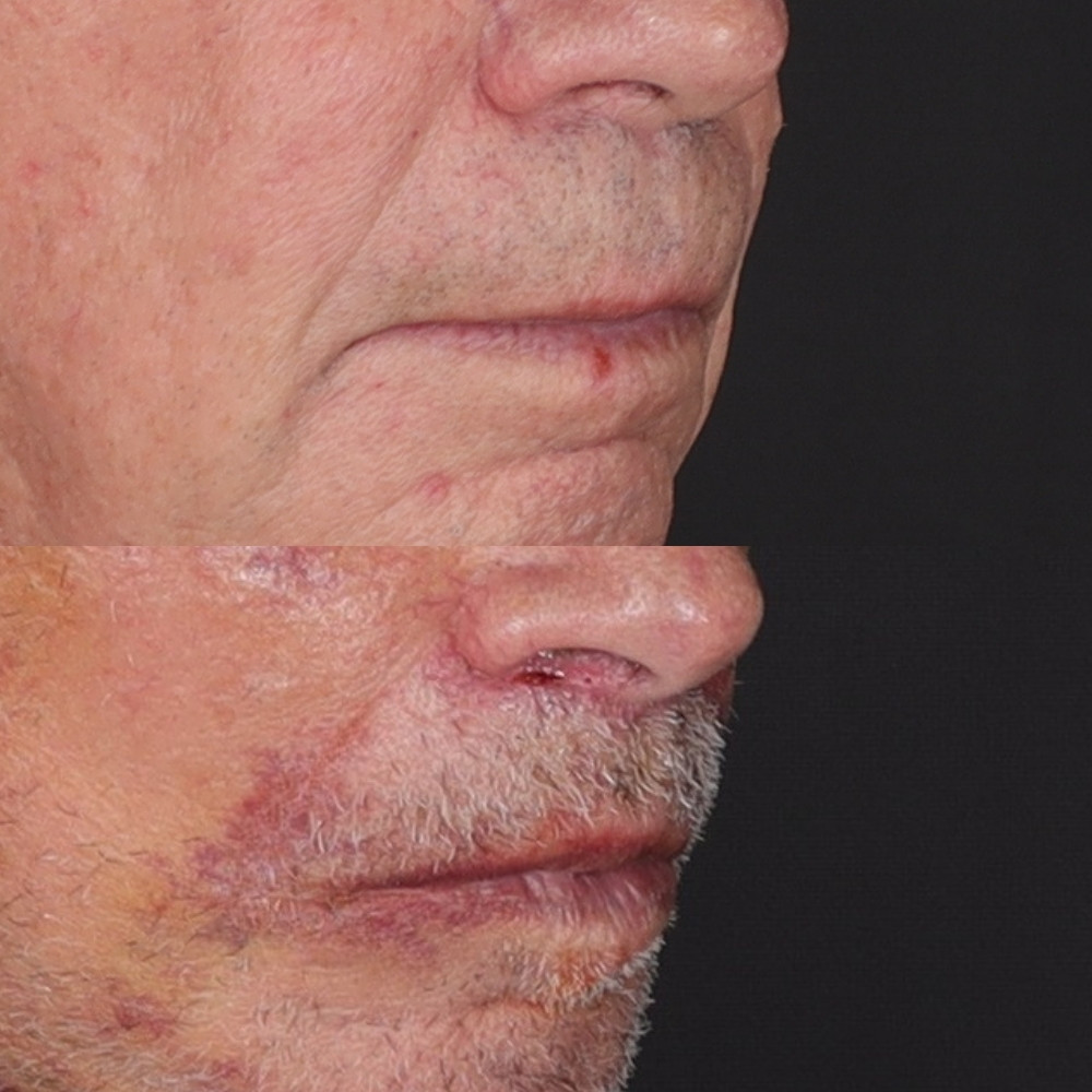 #5 Lip Lift, 74 y.o., 8 days