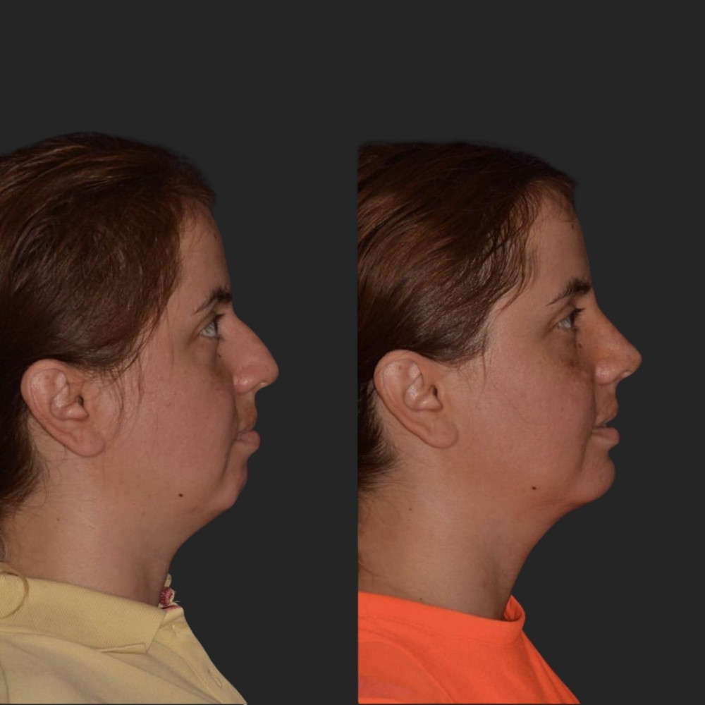 #6 Facial Implants, 42 y.o., 1 month
