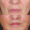 #6 Lip Lift, 67 y.o., 8 days