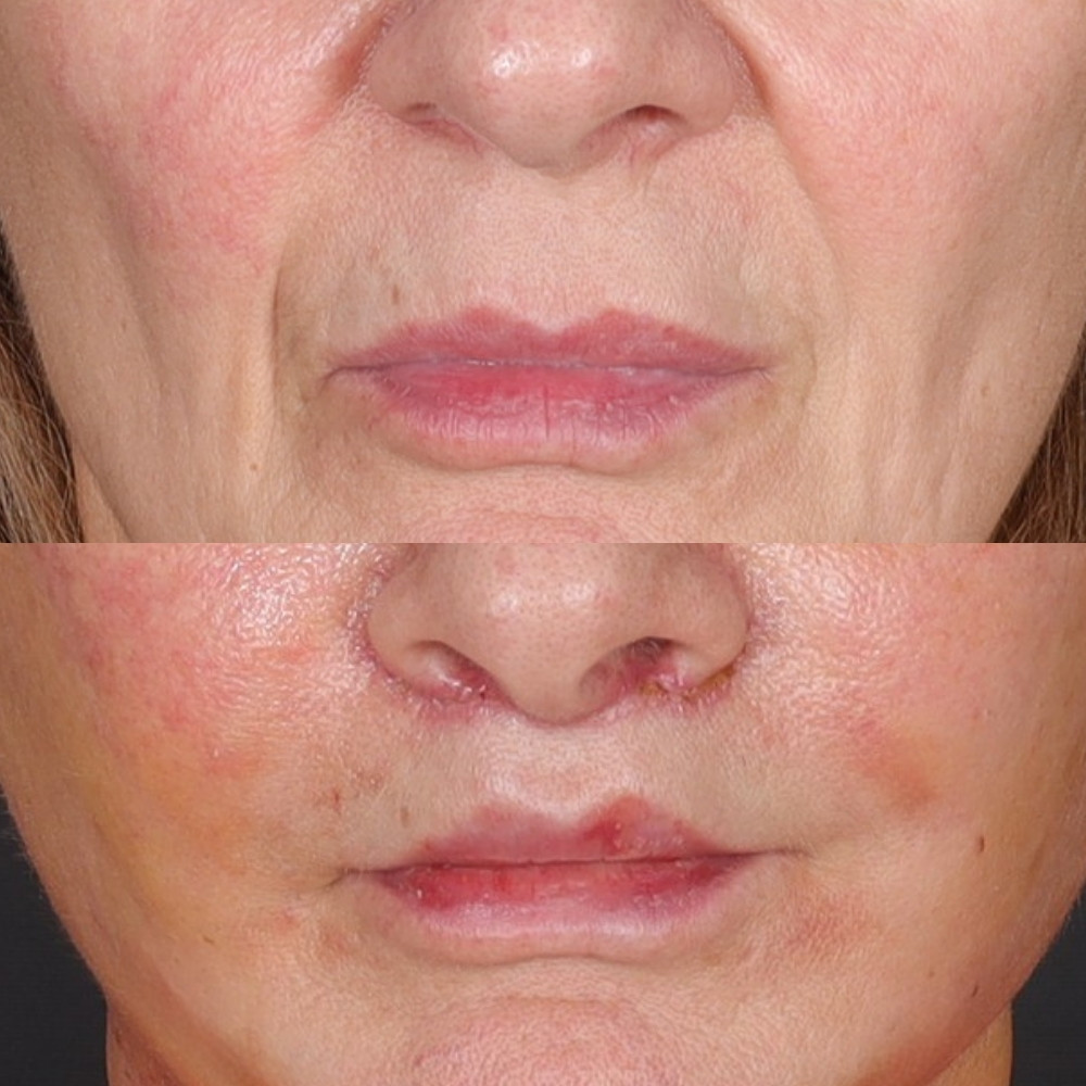 #6 Lip Lift, 67 y.o., 8 days