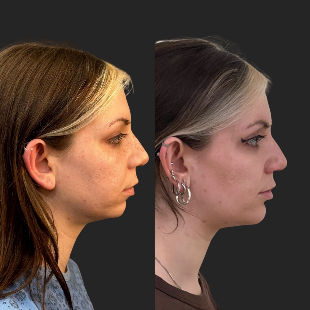 #7 (1) Facial Implants, 27 y.o., 1 month