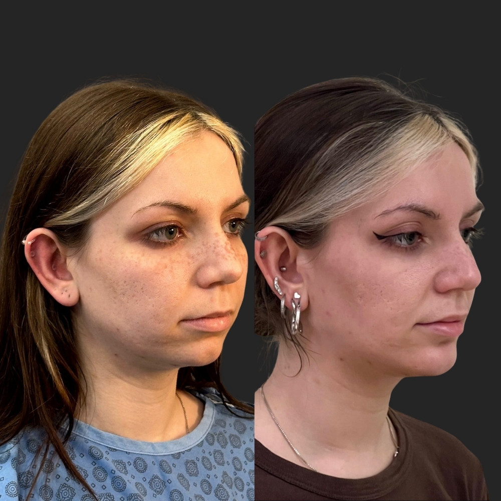 #7 (2) Facial Implants, 27 y.o., 1 month