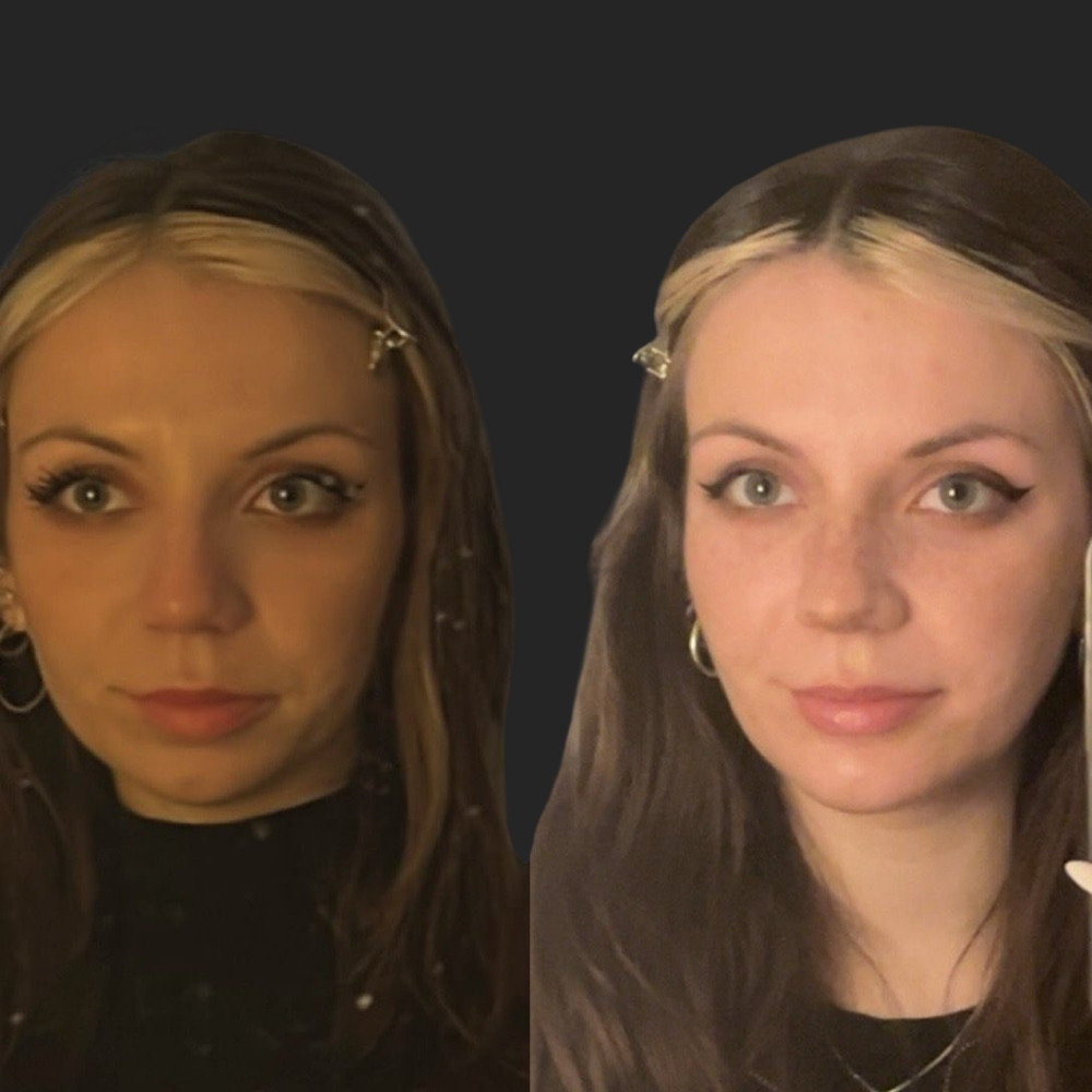 #7 (3) Facial Implants, 27 y.o., 1 month