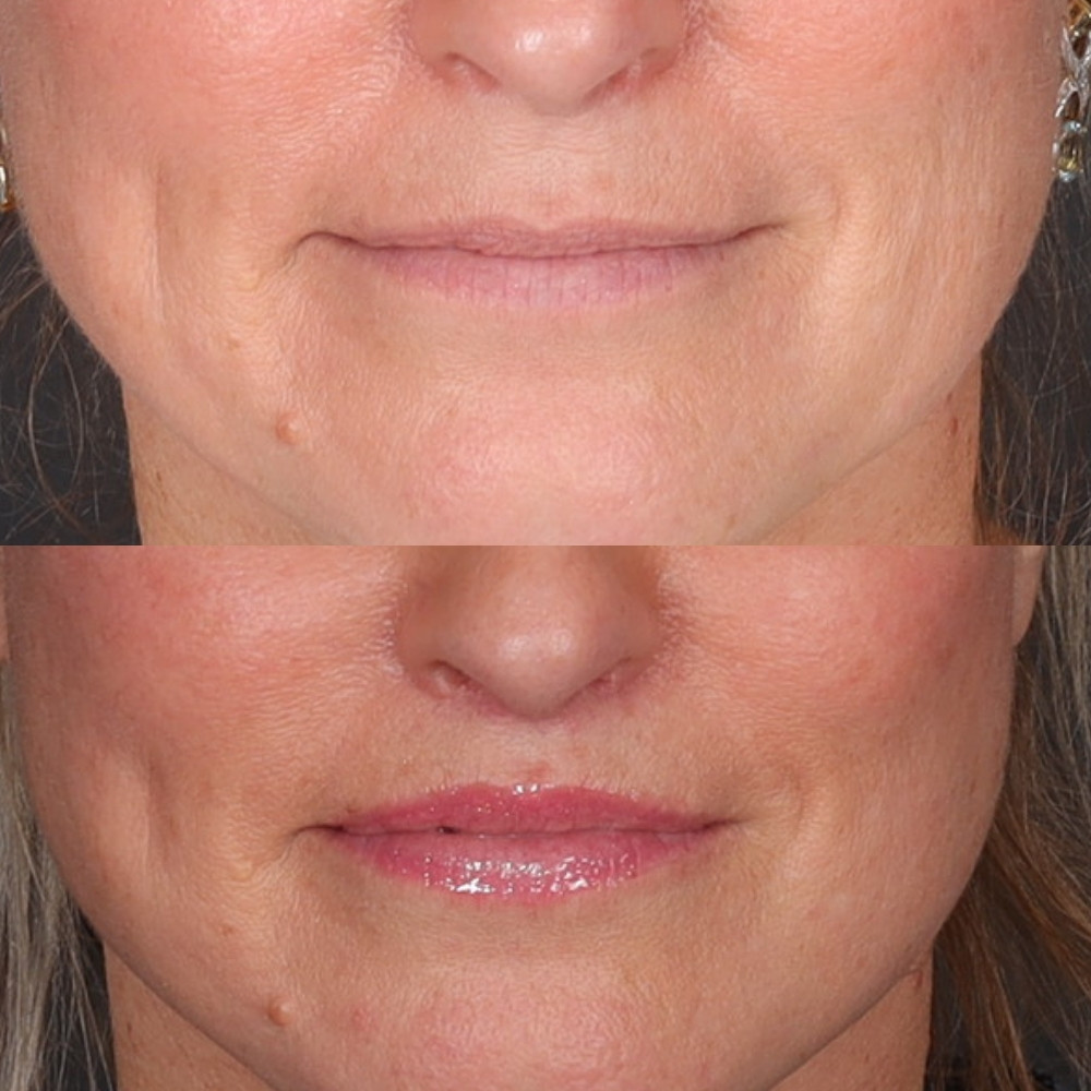 #7 Lip Lift, 56 y.o., 3 months