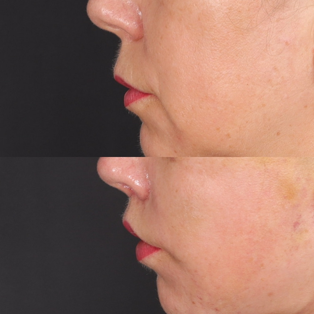 #8 Lip Lift, 52 y.o., 14 days