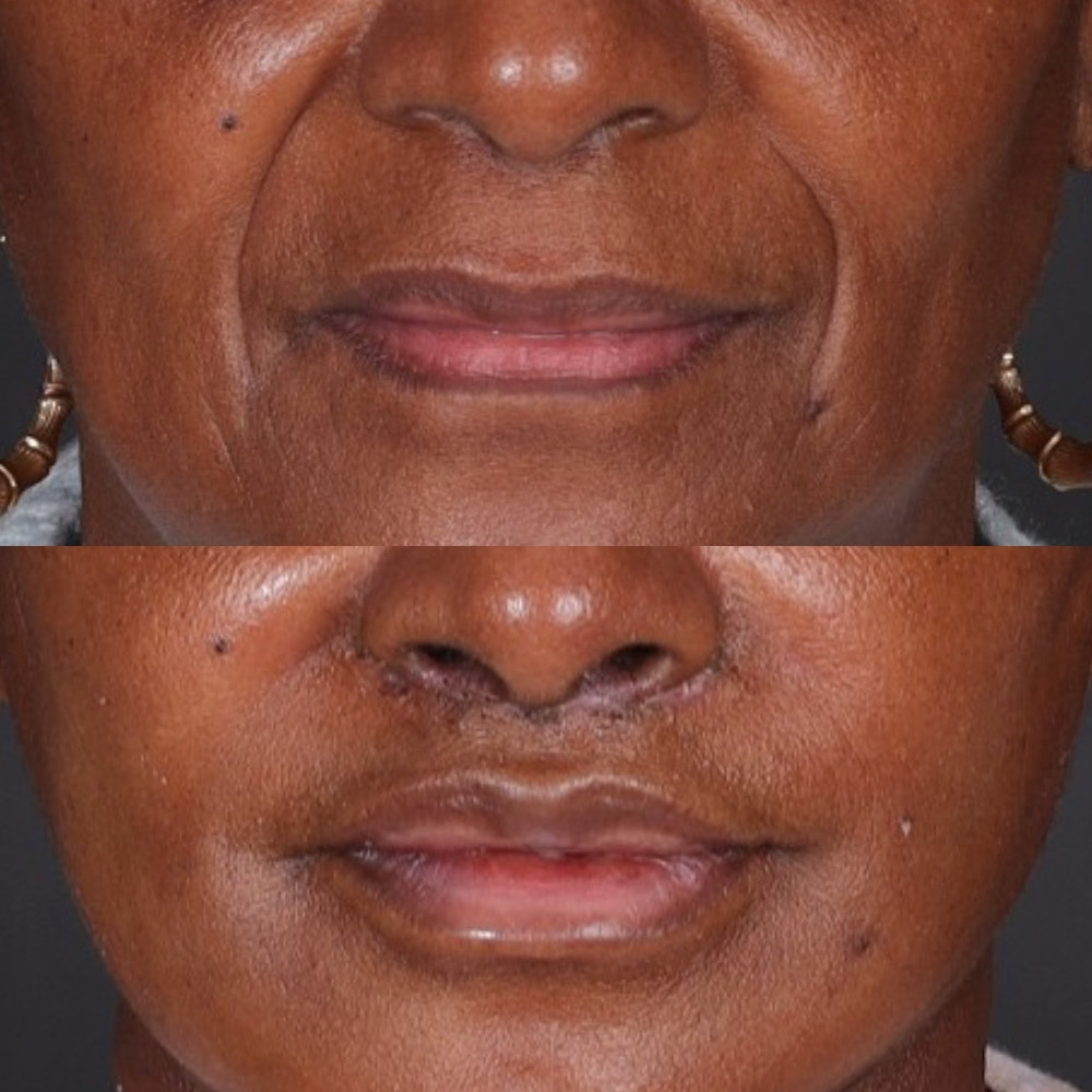 #9 Lip Lift, 63 y.o., 11 days