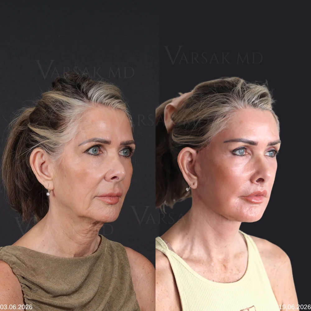 Before and After Facelift Patient 3